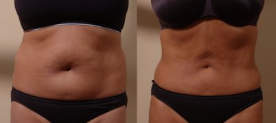 Bellevue Liposuction Body Contouring | Liposuction Body Contouring Seattle Washington