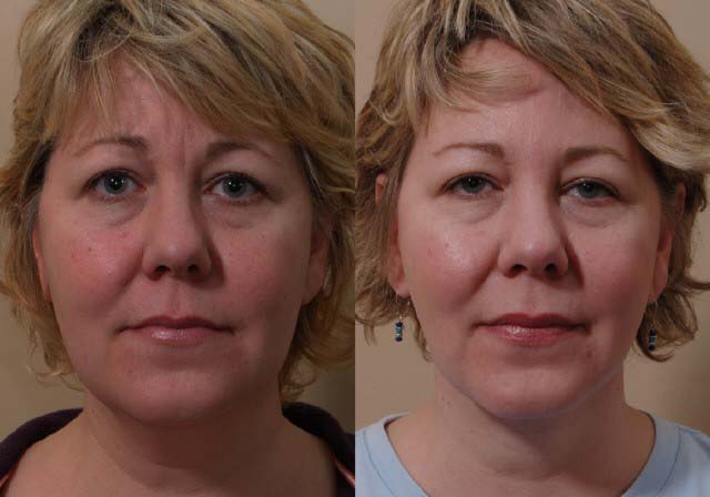 restylane_before_after