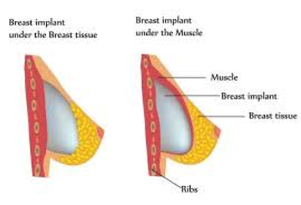 Types Of Breast Reconstruction for Beginners