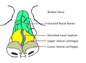 Broken Nose Rhinoplasty - Bel-Red Center