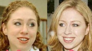 Chelsea Clinton Plastic Surgery