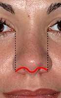 Rhinoplasty - Narrowing the Wide Nose 3