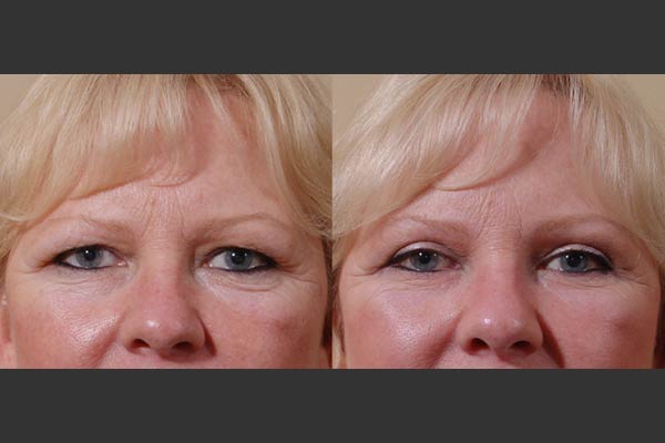 Asian Double Eyelid Crease Formation / Blepharoplasty and Medial  Epicanthoplasty Recovery Log - Blog Aesthetic Facial Body Plastic Surgery