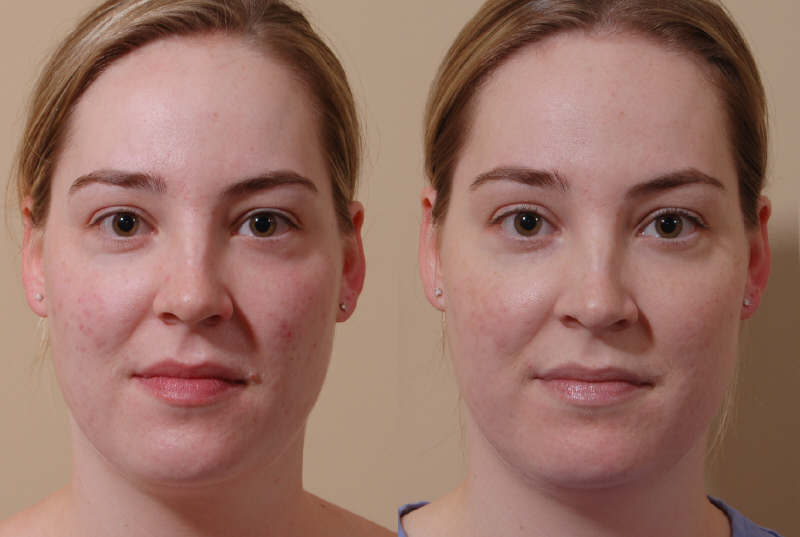 Bellevue, Seattle Procedures to Improve the Skin Surface - Belred Cosmetic Surgery