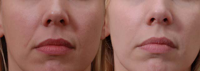 juvederm_before_after