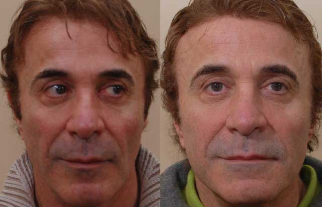 sculptra_before_after