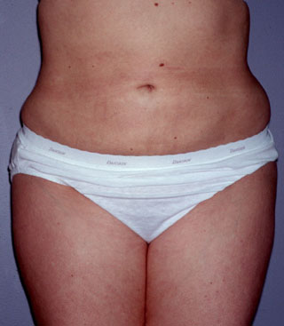 Abdominal Liposuction in Bellevue