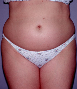 Abdominal Liposuction in Seattle