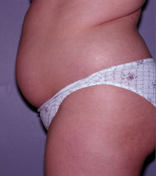 Bellevue Abdominal Liposuction