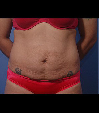 Liposuction of the Abdomen Abdominoplasty Tummy Tuck Bellevue