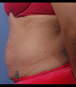 Liposuction of the Abdomen Abdominoplasty Tummy Tuck Tacoma
