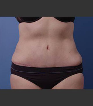 abdominoplasty and waist (lipo-abdominoplasty) Bellevue Washington