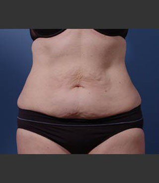 abdominoplasty and waist (lipo-abdominoplasty) Seattle