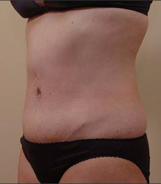 Abdominal Contour - Tummy Tuck (Abdominoplasty) Marysville Washington