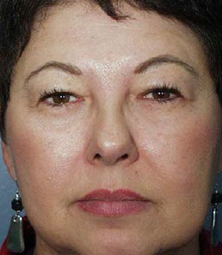 Upper & Lower Eyelid Lift For Decreased Peripheral Vision Tacoma Olympia Everett