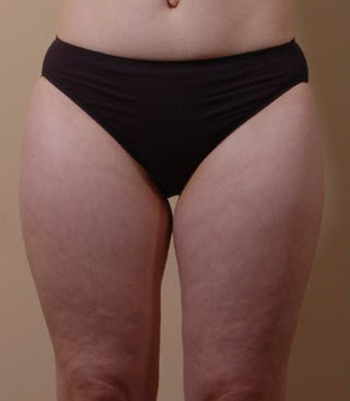 Bellevue, Seattle Liposuction Smartlipo Thighs Patient 5