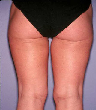 Bellevue, Seattle Liposuction Smartlipo Arms and Thighs Patient 7