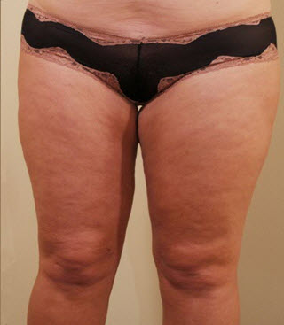 Bellevue, Seattle Liposuction Smartlipo Arms and Thighs Patient 8