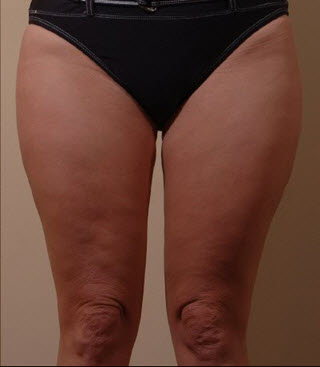 Bellevue, Seattle Liposuction Smartlipo Arms and Thighs Patient 9