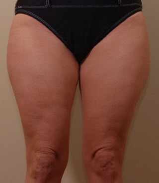 Bellevue, Seattle Liposuction Smartlipo Arms and Thighs Patient 9