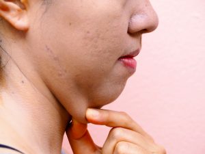 Double-Chin, Kybella