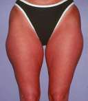 liposuction-thighs-before